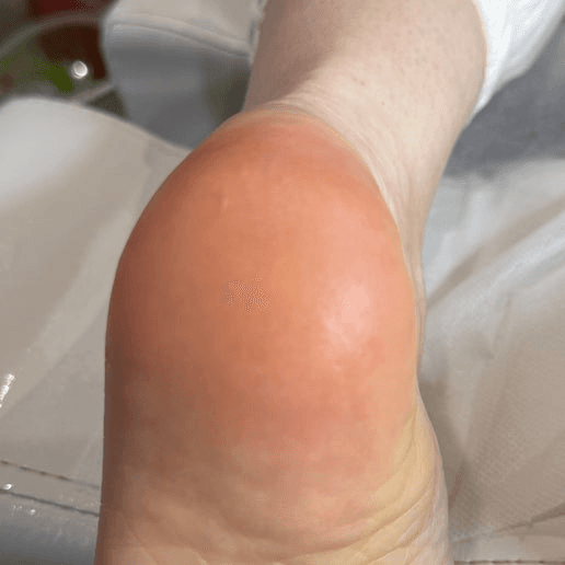 Feet (callus care)